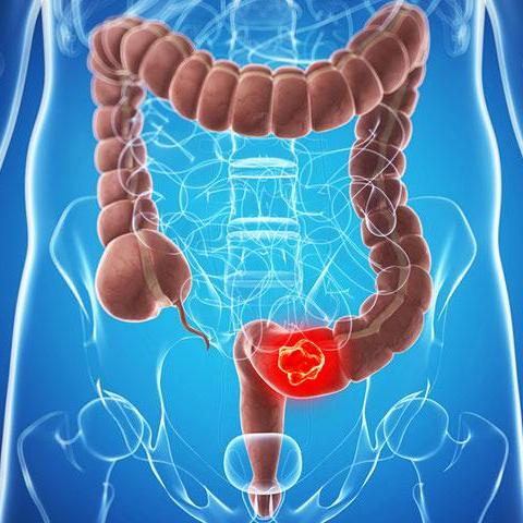 Colorectal Cancer in India